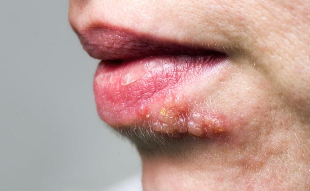 Zona Thần Kinh Có Lây Không? Giải Đáp Chi Tiết & Hướng Dẫn Phòng Ngừa